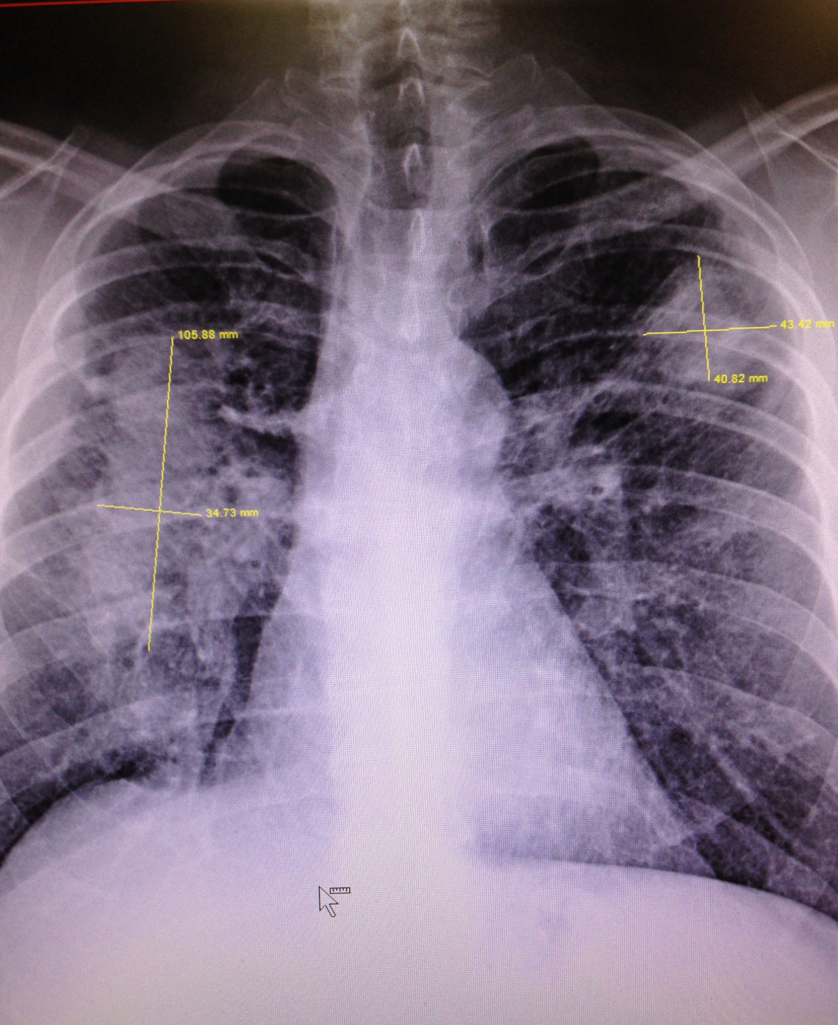 Forehand Lung with opacities outlined (1)